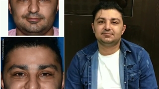 فیلم عمل بینی گوشتی مردانه + عکس بعد از جراحی