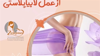 رضایت بیمار از عمل لابیاپلاستی توسط دکتر زارع پور