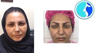 رضایت مراجعه کننده عزیز بعد از برداشتن گچ بینی