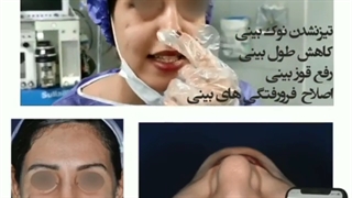 فیلم عمل بینی استخوانی قوزدار در مشهد