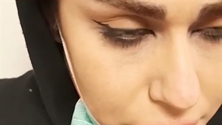 نتیجه کاشت ابرو بعد از دو سال| کلینیک ابروان