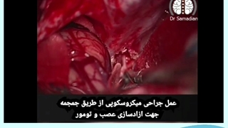 تومور عصب بینایی(گیلوم)با حفظ کره