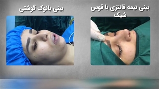 تبدیل بینی گوشتی به بینی با نوک نیمه فانتزی ‌ قوس شیک