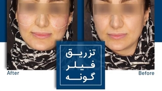 تزریق فیلر گونه