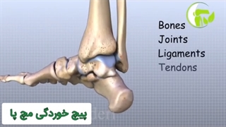 پیچ خوردگی مچ پا