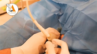 درمان شانه یخ زده