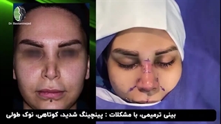 جراحی بینی ترمیمی با روش ابداعی | دکتر باستانی نژاد