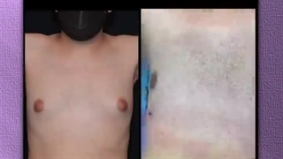 جراحی سینه در آقایان | دکتر رفیع | جراح سینه تهران