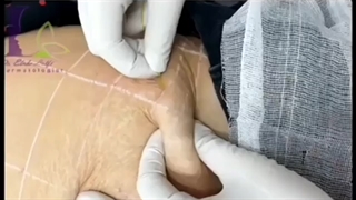 فیلم واقعی اندولیفت شکم و رضایت بیمار