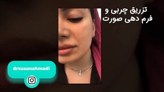 تزریق چربی، بهترین روش برای فرم دهی صورت زیبایی پوست