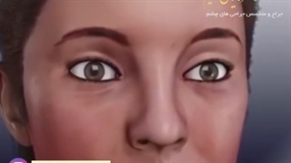 انیمیشن بلفاروپلاستی