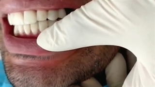 اصلاح طرح لبخند