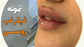 فیلم تزریق ژل لب روسی کاملا طبیعی با ماندگاری بالا