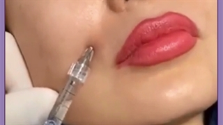 بهترین کلینیک زیبایی اصفهان برای تزریق چربی و ژل برداشتن خال
