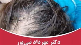 تقویت موی سر با فیلر مو