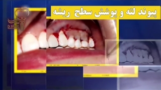 فیلم پیوند لثه و پوشش سطح ریشه