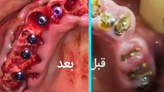 فیلم واقعی و بدون سانسور ایمپلنت فوری