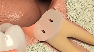 عوارض نکشیدن دندان عقل نهفته