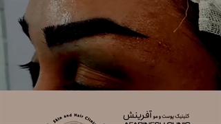 بهترین دکتر کاشت ابروی تخصصی | کلینیک آفرینش