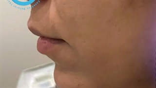 تزریق فیلر چانه توسط دکتر آذر مسرور| کالج cntaa