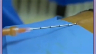 بهترین مرکز برای تزریق ژل و چربی در اصفهان کاشت مو