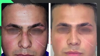 جراحی اولیه بینی با پارگی در ناحیه ریشه بینی | دکتر باستانی نژاد