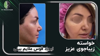 جراحی بینی ترمیمی با اصلاح کجی بینی | دکتر باستانی نژاد