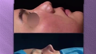 جراحی بینی فانتزی | دکتر رفیع | جراح پلاستیک تهران
