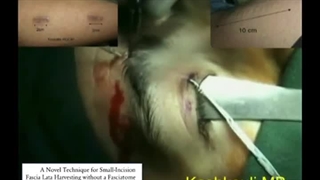 فیلم برداشت فشیالاتا برای استفاده در جراحی افتادگی پلک | پروفسور کشکولی