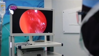 پاسخ به سوالات درباره پولیپ بینی