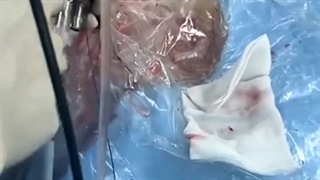 فیلم عمل سنگ کلیه به روش بسته