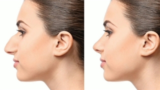 رینوپلاستی