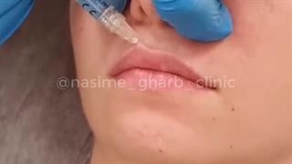 تزریق ژل لب مدل روسی