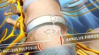 فتق یا پارگی دیسک چگونه به وجود می آید؟