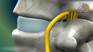 فیلم واقعی جراحی دیسک کمر