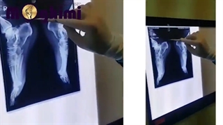 عمل جراحی استخوان اضافه پشت پاشنه پا