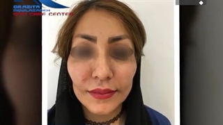 فیلم واقعی تزریق چربی به صورت