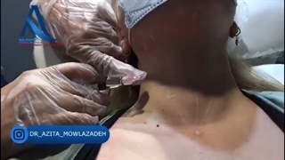 فیلم واقعی تزریق پروفایلو به گردن جهت آبرسانی و جوانسازی