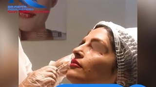 نحوه انجام تزریق ژل جهت رفع گودی زیر چشم