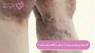 احتمال برگشت پذیری بیمارى واریس پس از درمان چند درصد است؟