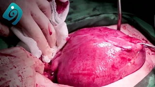 فیلم واقعی و بدون سانسور جراحی هیسترکتومی و چسبندگی بیش از حد رحم