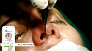 فیلم کامل جراحی بینی