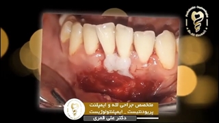 فیلم جراحی پیوند لثه ۲ دندان به صورت همزمان در فک پایین