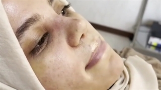 سه هفته بعد از عمل بینی