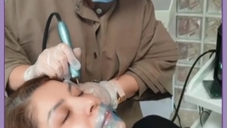 لیفت چشم بدون جراحی ترمیم ونیر