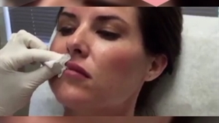 به لب تزریق چربی انجام بدهم یا تزریق ژل؟ جوانسازی پوست