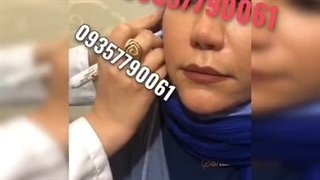 آموزش فیلر تزریق ژل اصلاح فرم صورت