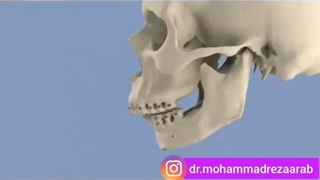 عمل جراحی فک چگونه انجام می شود؟