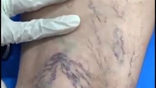فیلم واقعی اسکلروتراپی رگ های واریسی