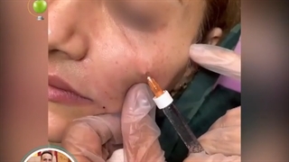 فیلم واقعی تزریق ژل زیر چشم